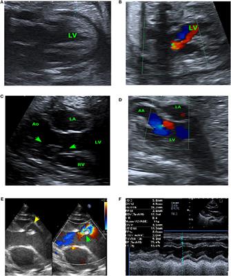 Prenatal Diagnosis of Aorto-Left Ventricular Tunnel With Dysplastic Bicuspid Aortic Valve: From Fetal Cardiac Failure to Favorable Outcome